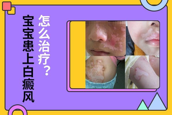 诊断治疗-冬天治疗白癜风要注意什么